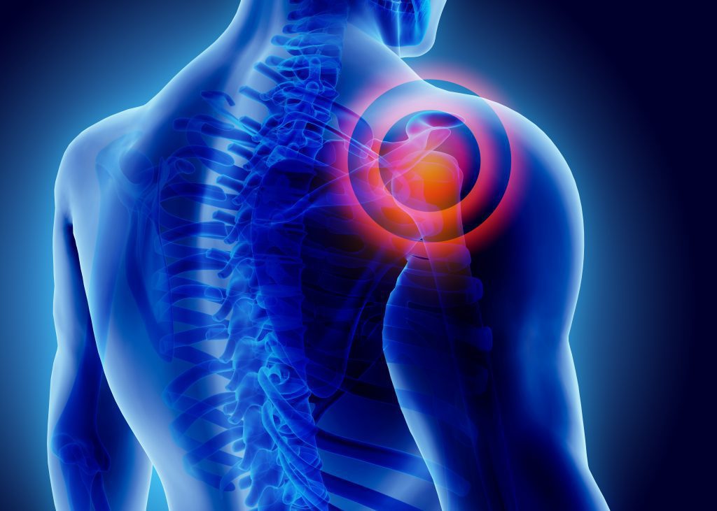 X Ray image of shoulder injury caused by car accident